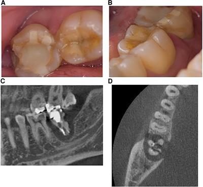 Case report: Delayed autologous tooth transplantation based on objective bone healing of the extraction socket (4-year follow-up)